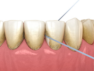 Oral hygiene: using dental floss for plaque removing. Medically accurate dental 3D illustration