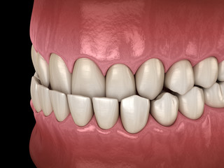 Alt Text: A 3D illustration of underbite dental occlusion (Malocclusion of teeth). 