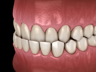 Underbite dental occlusion ( Malocclusion of teeth ). Medically accurate tooth 3D illustration