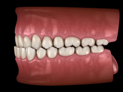 Underbite dental occlusion ( Malocclusion of teeth ). Medically accurate tooth 3D illustration