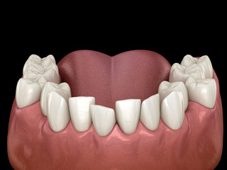 Abnormal teeth position, orthodontic concept. Medically accurate tooth 3D illustration