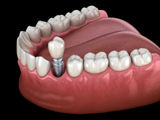 Premolar tooth recovery with implant. Medically accurate 3D illustration of human teeth and dentures concept