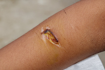 Lesion on arm skin begin scab dried on the epidermis.