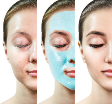 Young woman face before and after blue vitamin facial clay mask.