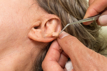 Woman who had ear acupuncture treatment done having the ear studs removed 

