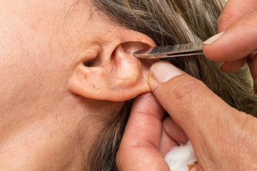 Woman who had ear acupuncture treatment done having the ear studs removed 

