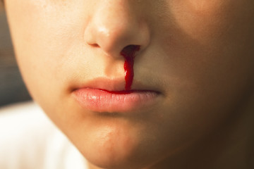 Epistaxis. Nosebleed , a young woman suffering from nose bleeding. Healthcare and medical concept . Selective focus - obrazy, fototapety, plakaty
