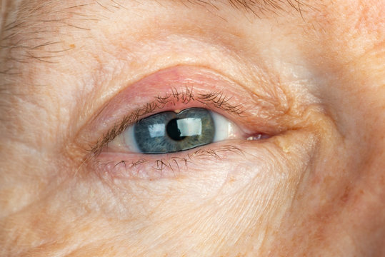 Macro shot of an eye with a stye filled with pus on the eyelid