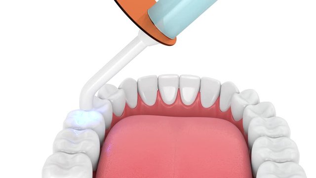Jaw with dental polymerization lamp and light cured inlay filling 