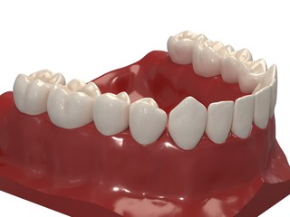 Removable orthodontic appliance is used after orthodontic treatment for retention. 3d render