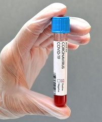 Coronavirus positive test result blood sample