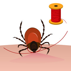 A tick is taken out of the skin with a thread. Tick bite. Vector illustration