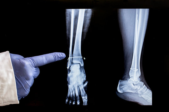 X-ray of the leg after surgery