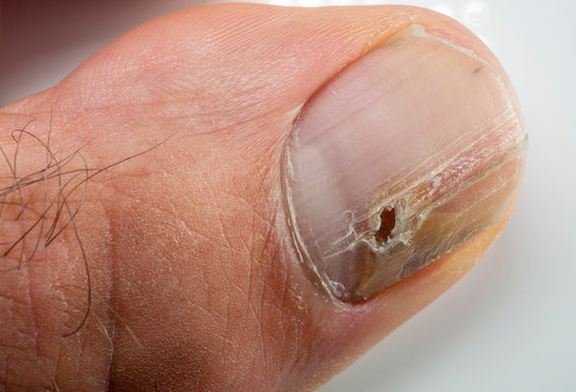 Nail infections caused by fungi such as: onychomycosis also known as tinea unguium. Thumb infection. Caused by dermatophytes and yeasts and for the concomitant antibacterial activity