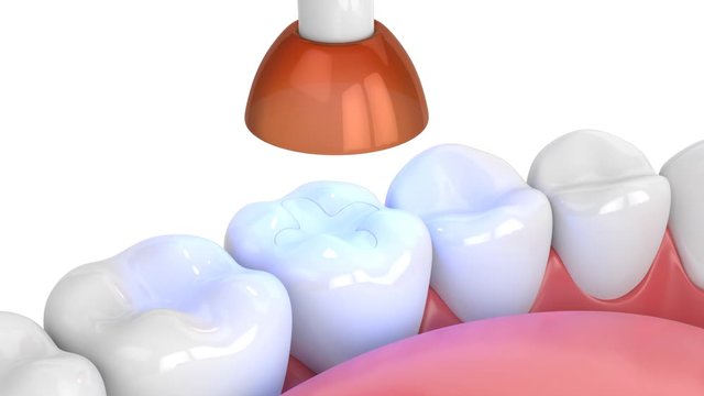 Jaw with dental polymerization lamp and light cured inlay filling 

