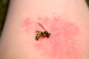 Wespe auf einem Arm mit einem Wespenstich