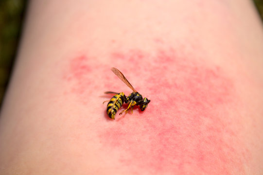 Wespe auf einem Arm mit einem Wespenstich