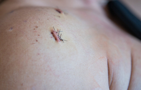 Close Up Of A Patient 3 Stitches From A Surgery From A Shoulder Procedure With 