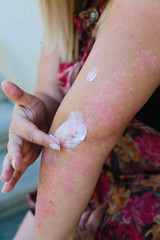 applying an emollient to dry flaky skin as in the treatment of psoriasis, eczema and other dry skin...