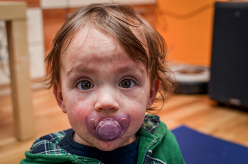 Children viral disease or allergies. Red measles rash on baby.