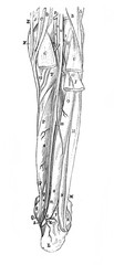 Muscles and veins of the leg from the back in the old book Surgery Atlas by Dr. Greb, St. Petersburg, 1869