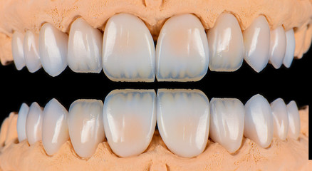 full upper jaw press ceramic veneers b1 color © Garo
