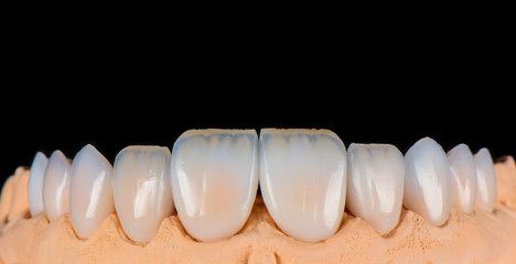 full upper jaw press ceramic veneers b1 color © Garo