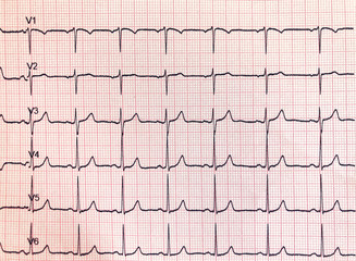 Electrocardiogram hospital examination. Sheet that represents a diagnostic test, of an instrumental type, which records and graphically reports the rhythm and electrical activity of the heart