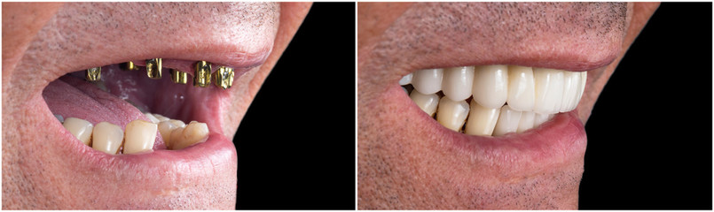 before and after pictures of dental implants and press cerami crowns