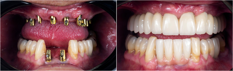 before and after pictures of dental implants and press cerami crowns