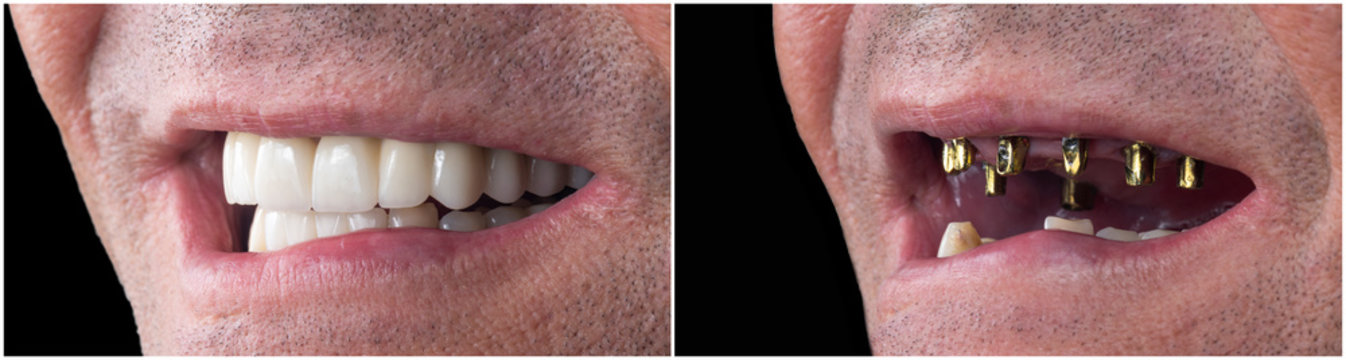 before and after pictures of dental implants and press cerami crowns