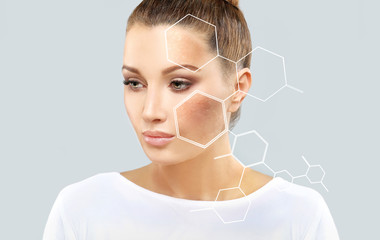 Dark spots, freckles,hyperpigmentation(melasma or chloasma),concept- skin lightening, skin...