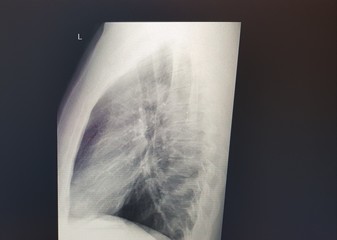 x ray image of human chest