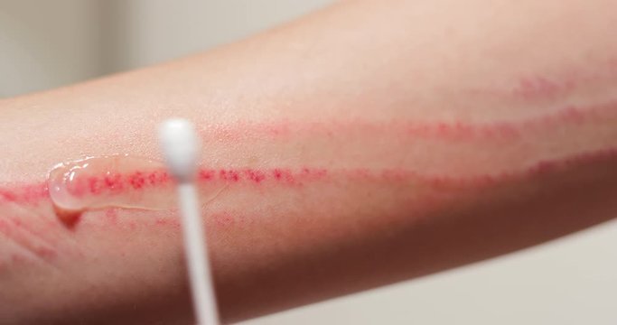 Apply ointment on forearm