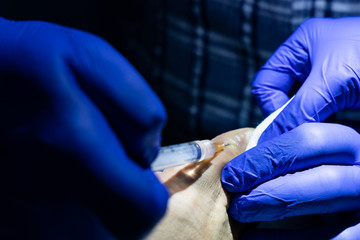 Series of ingrown toenail treatment. Medical doctor injecting local anesthetic into toe