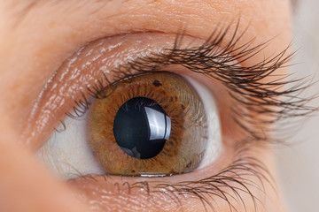 Macro eye photo. Keratoconus 2 degree - eye disease, thinning of the cornea in the form of a cone....
