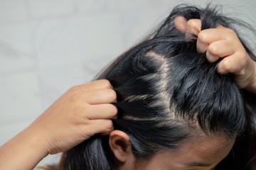 Fototapeta premium Bald woman hair loss from shampoo allergy