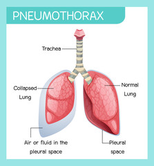 Pneumothorax cartoon of human anatomy