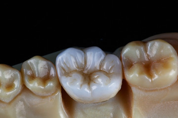 zircon crown of the chewing tooth on a model made on a 3D printer, shot from above on a black...