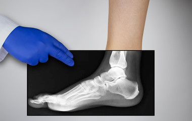 X-ray of a woman's foot. A photograph of the leg bones is applied to the patient's feet. The...