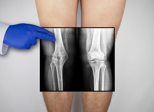 X-ray of a man's knees. A photograph of the knee caps and parts of the bones are applied to the patient's feet. The radiologist examines the X-ray.