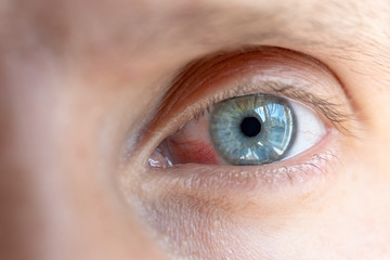 male inflamed eye with red capillaries