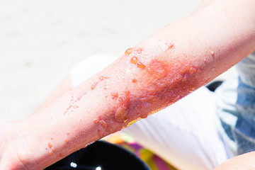 Severe poison ivy rash and infection on arm