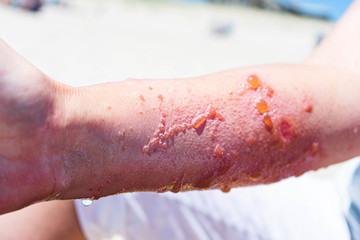 Severe and painful poison ivy rash and infection with blisters and oozing 