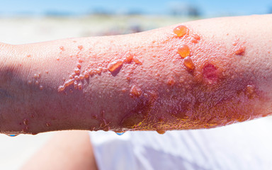 Severe and painful poison ivy rash and infection with blisters and oozing 