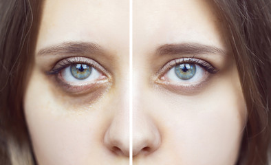 Female green eyes with bruises under eyes before and after cosmetic treatment. Dark circles under the eyes