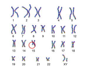 Karyotype of Angelman syndrome