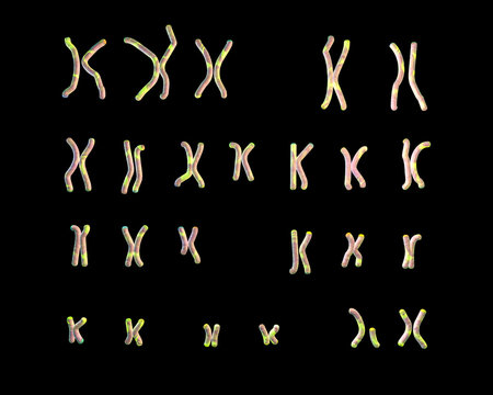 Karyotype Of Angelman Syndrome