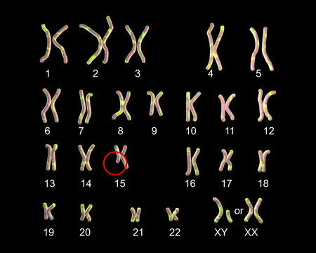 Karyotype Of Angelman Syndrome