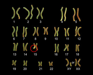 Karyotype of Angelman syndrome